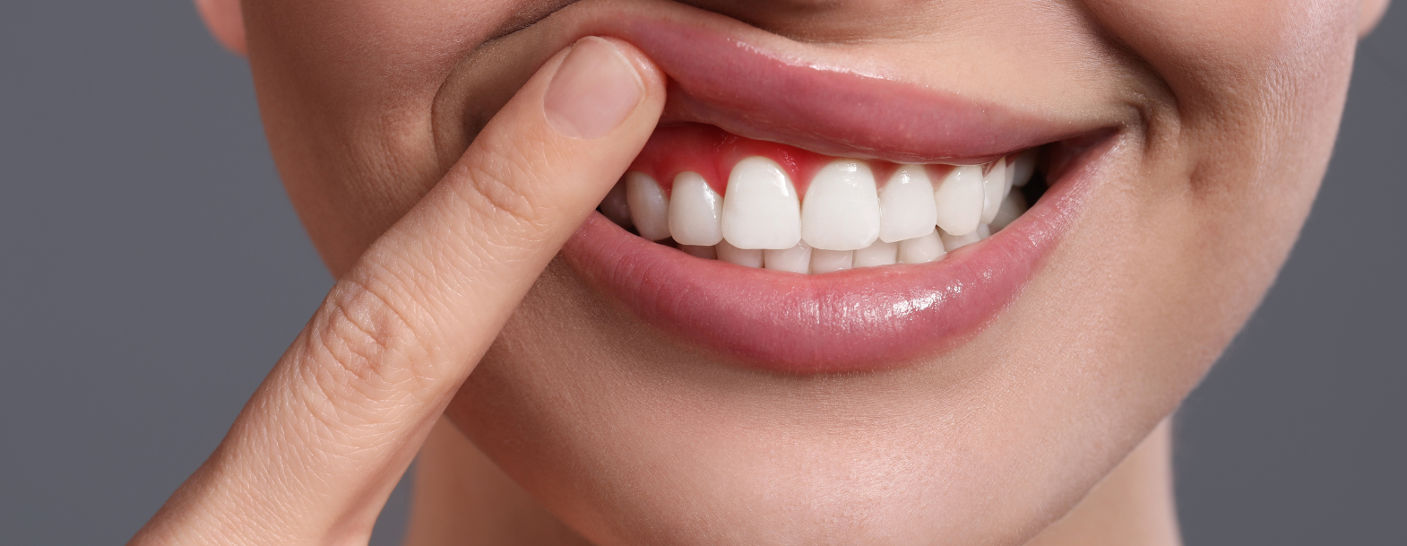 gum disease lady with sore red gums