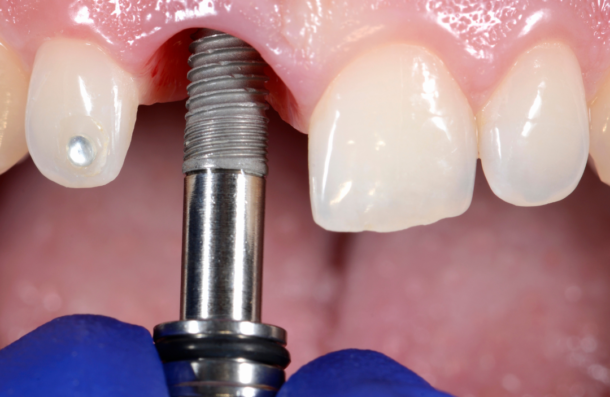 Dental Implants close up