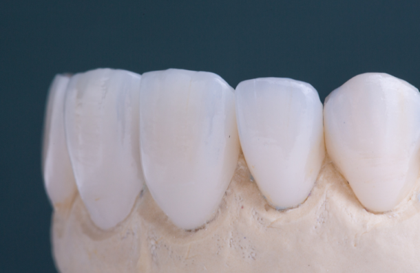 Dental Crowns, Onlays and Bridges