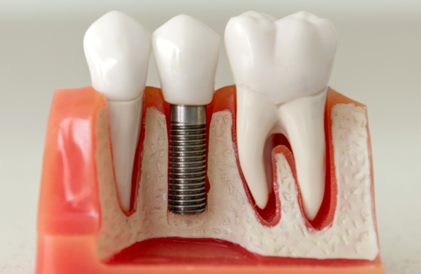 Dental Implant diagram model