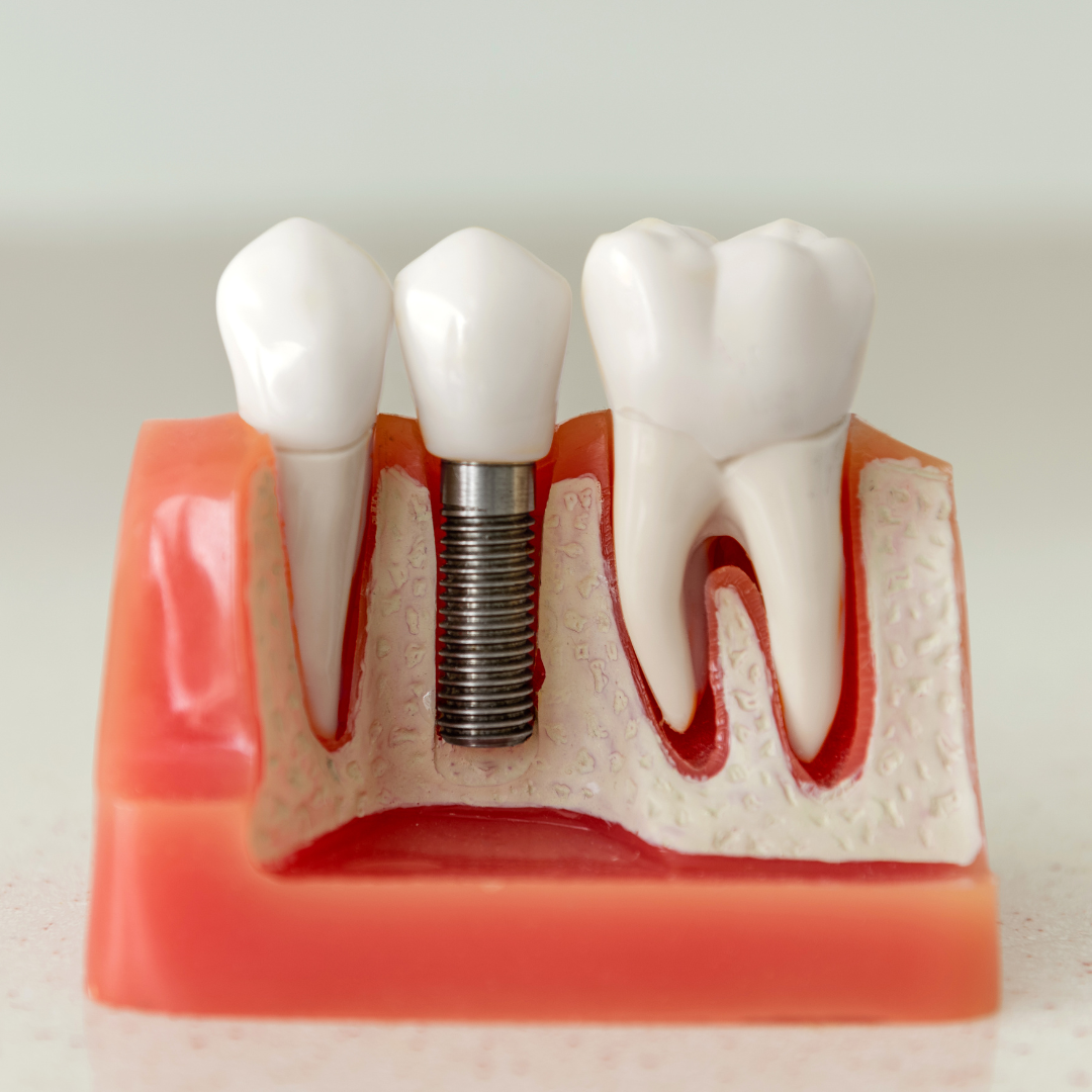Dental Implant diagram model