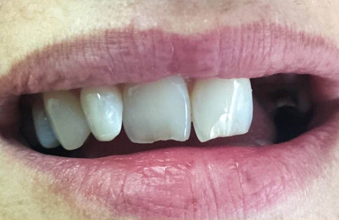 Dental Implant Case before placement