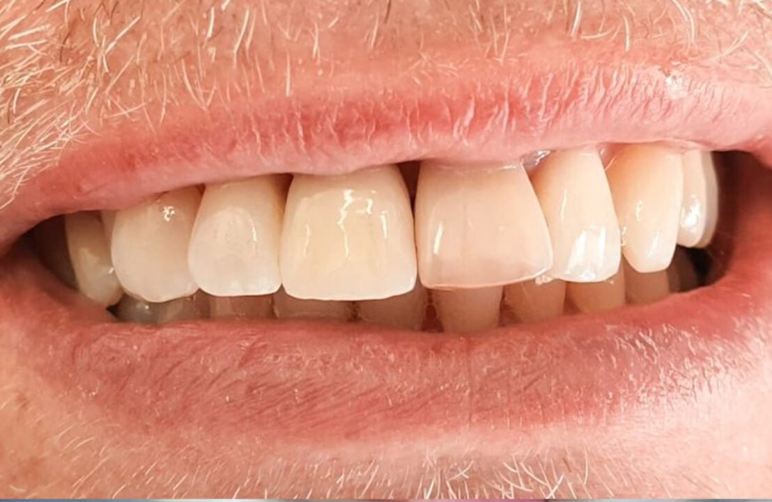 Dental Implant Case after placement