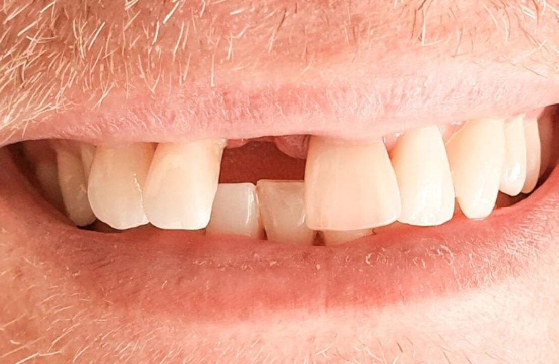 Dental Implant Case before placement