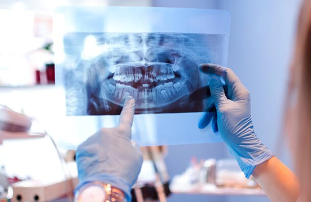 Failed and Complex Tooth Extraction