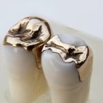 crown bridge gold onlay