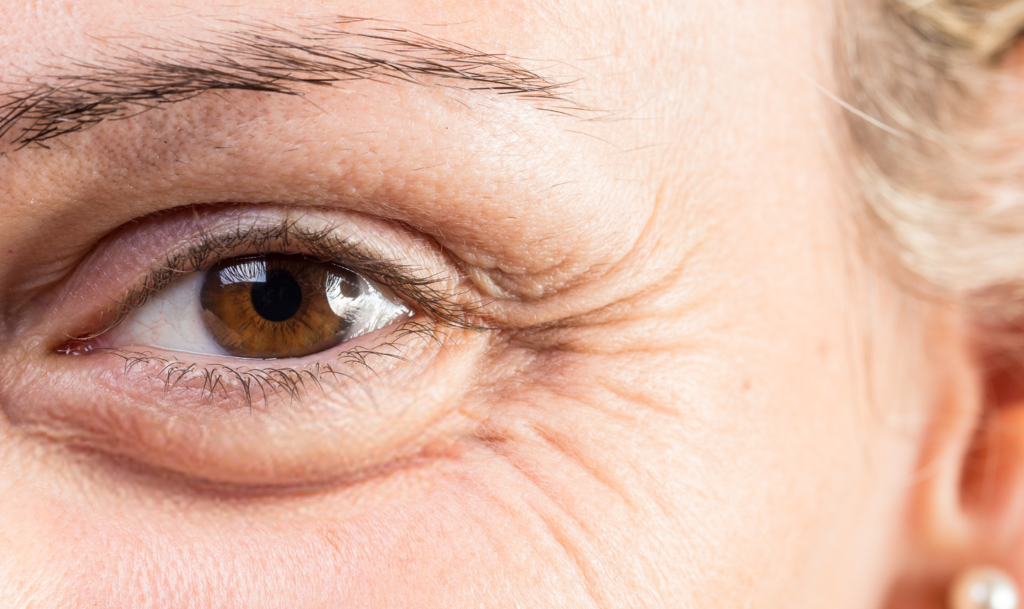 anti wrinkle crows feet Modbury
