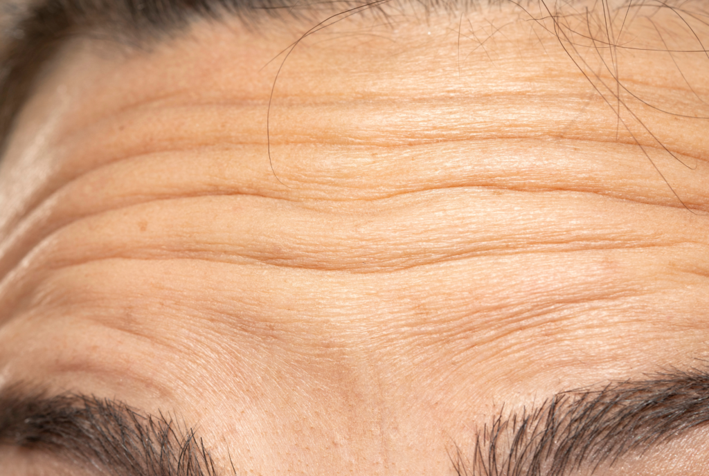 anti wrinkle forehead lines Modbury