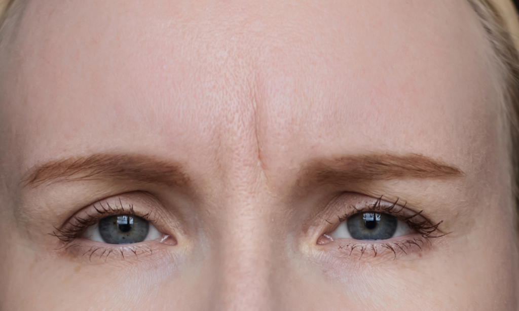 Antiwrinkle frown modbury