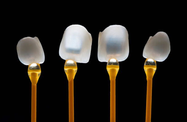 dental veneer
