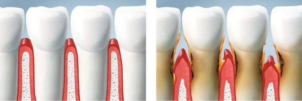 Gum disease graphics