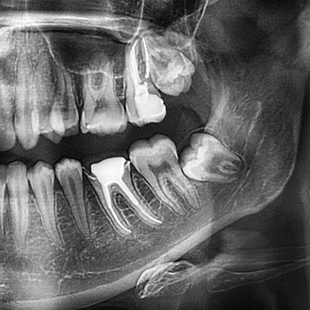 impacted wisdom tooth OG radiograph