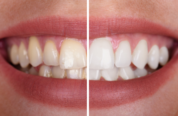 Whitening before/after