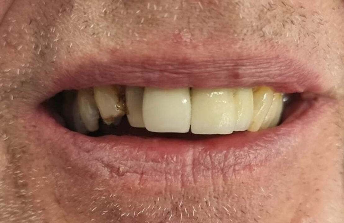 Dental Implant Case before placement