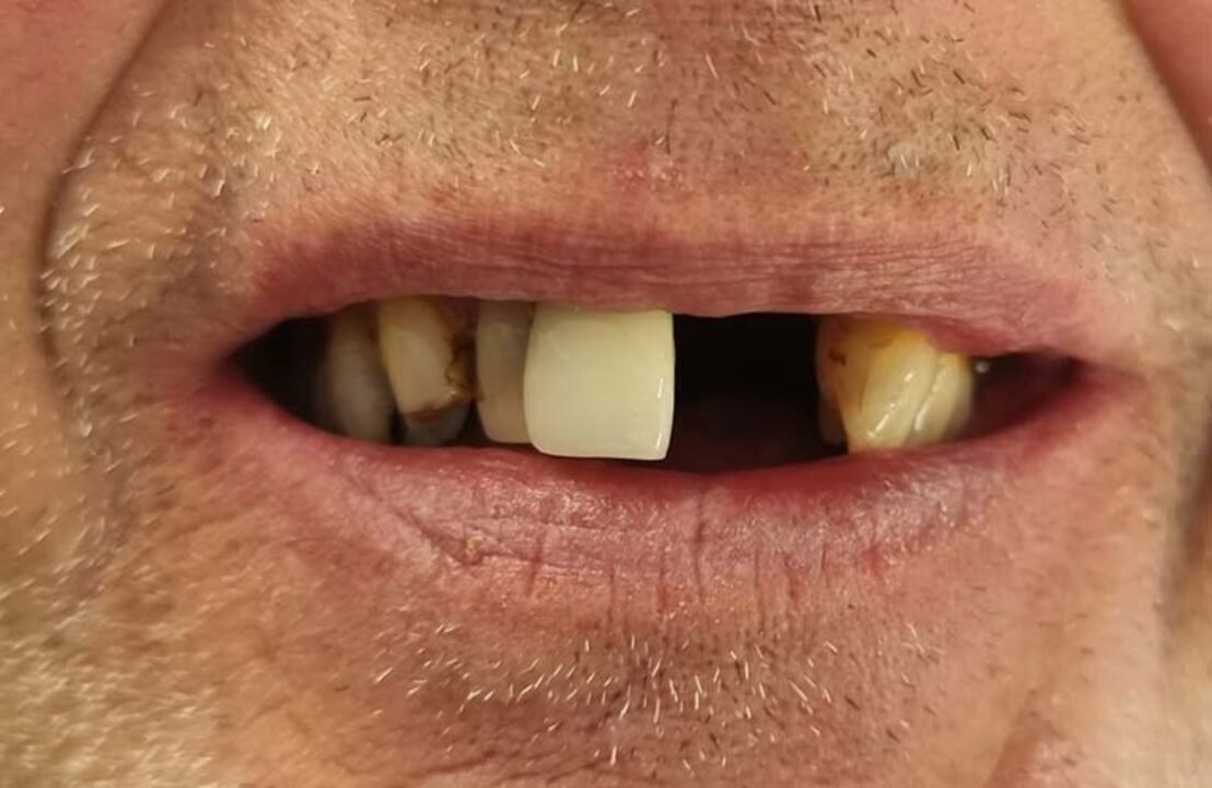 Dental Implant Case before placement