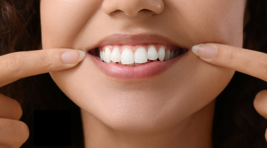 Composite Bonding white teeth