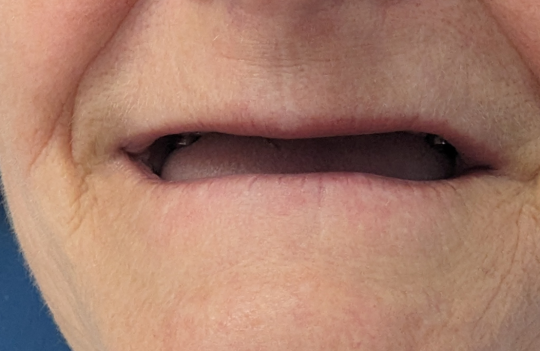 Dental Implants-A Transformational Journey before placement