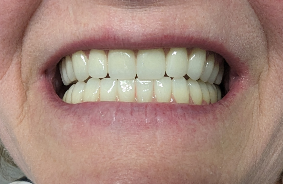 Dental Implants-A Transformational Journey after placement