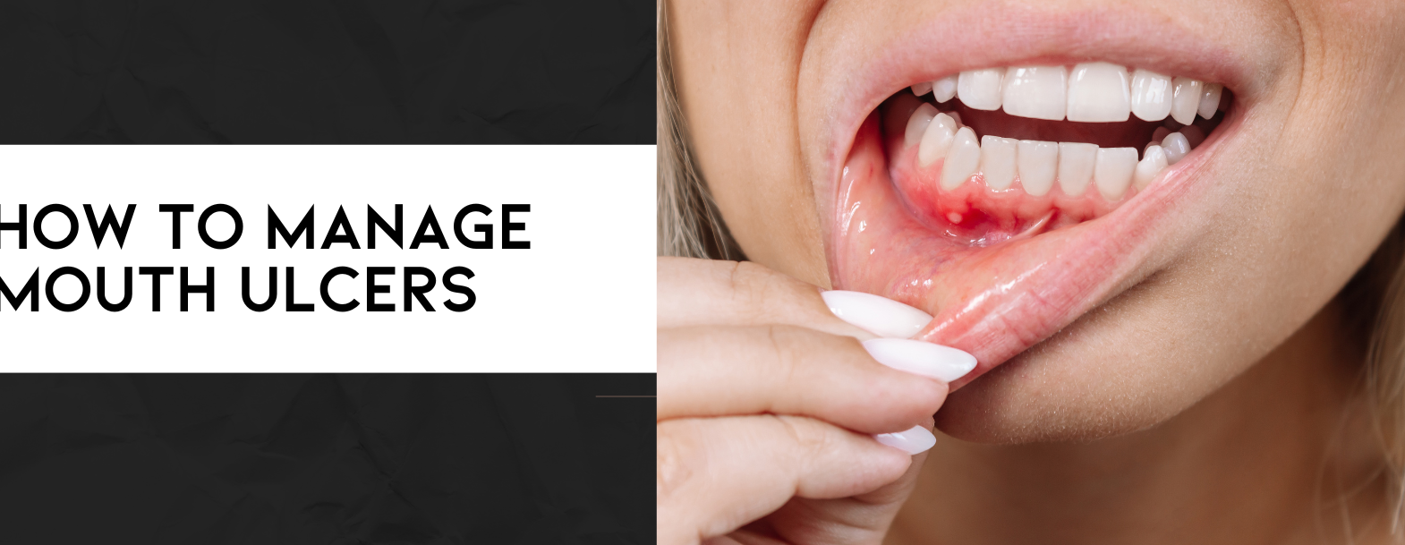 how to manage mouth ulcers