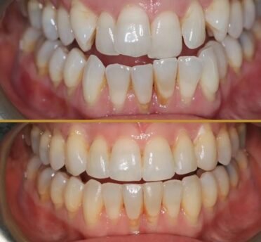 Invisalign before & after