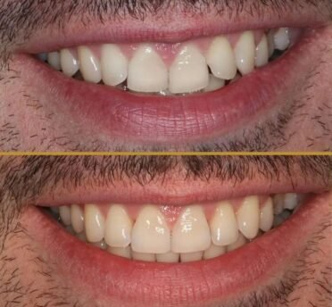 Invisalign before & after