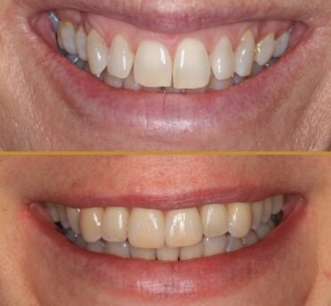 Invisalign before & after