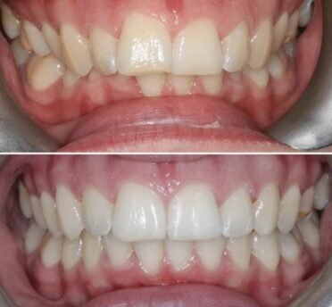 Invisalign before & after