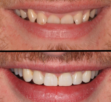 Invisalign before & after