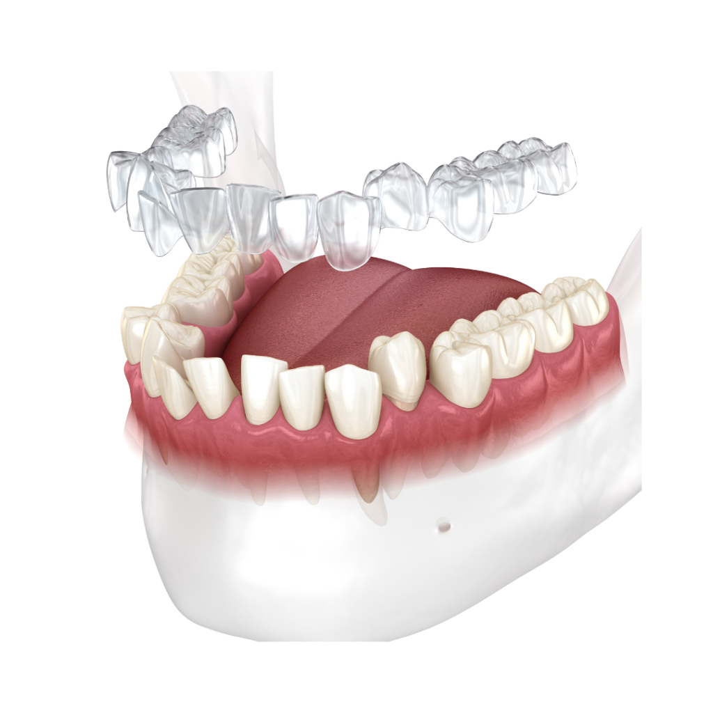 Clear aligner diagram