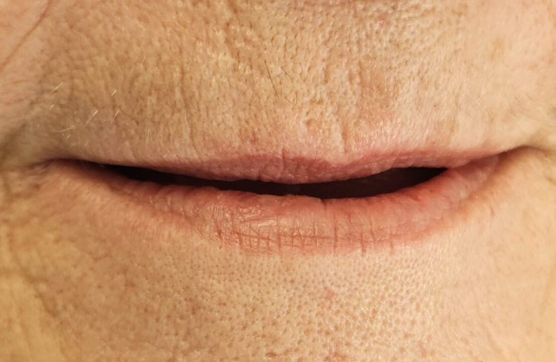 Full mouth Rehab with Dental Implants before