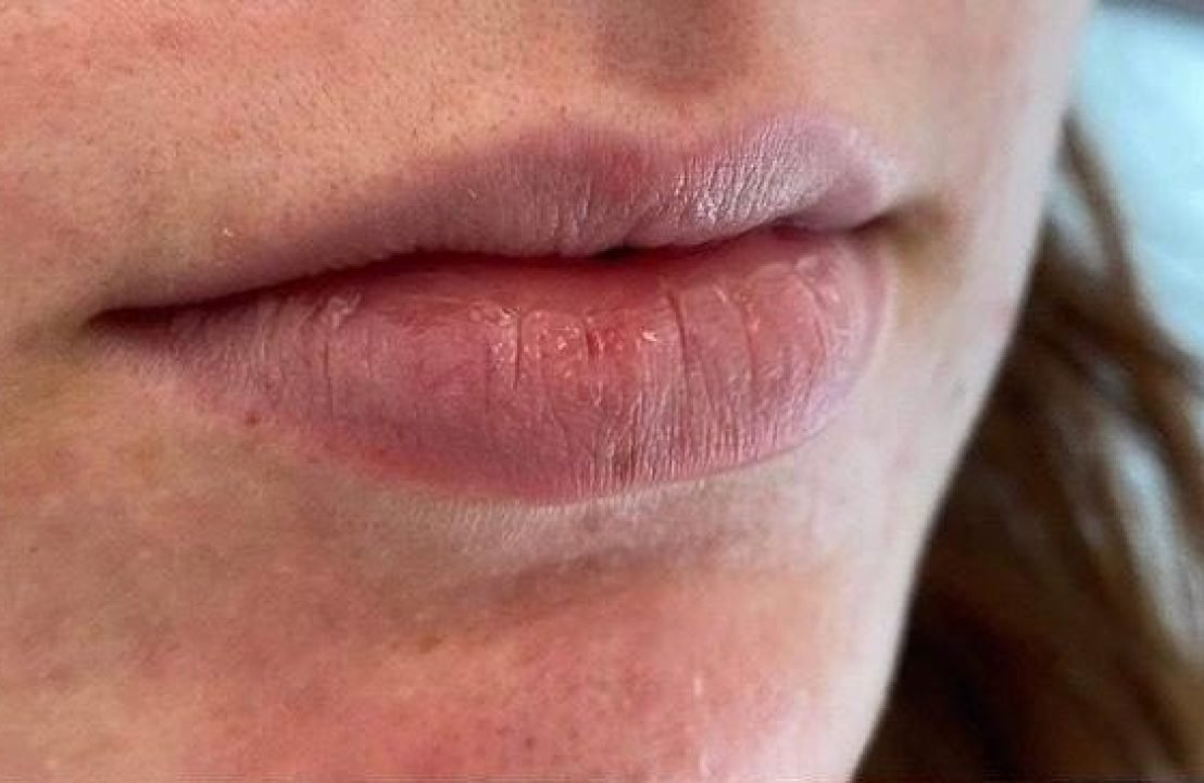 facial fillers after