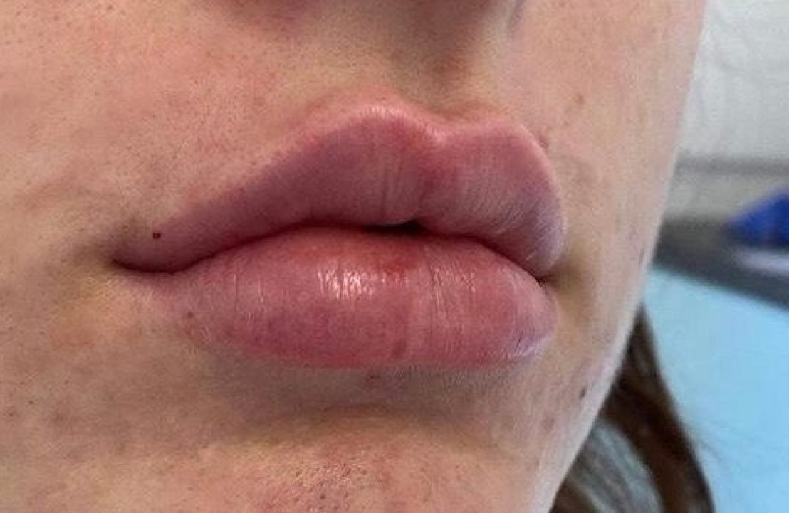 facial fillers after