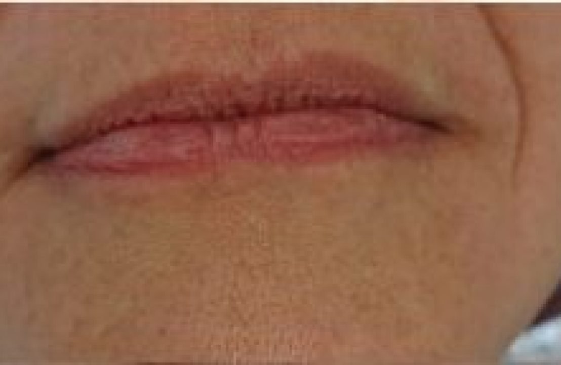 facial fillers Lip filler before