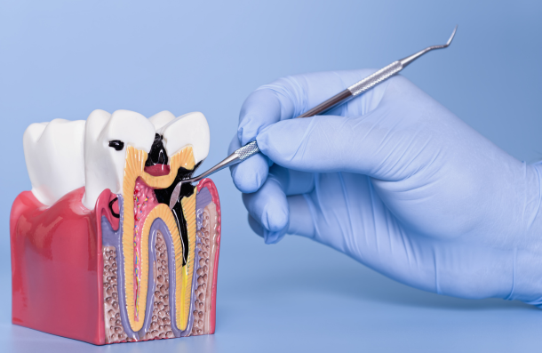 Tooth decay shown on a model