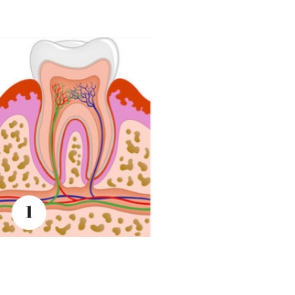 stage 1 of tooth decay diagram