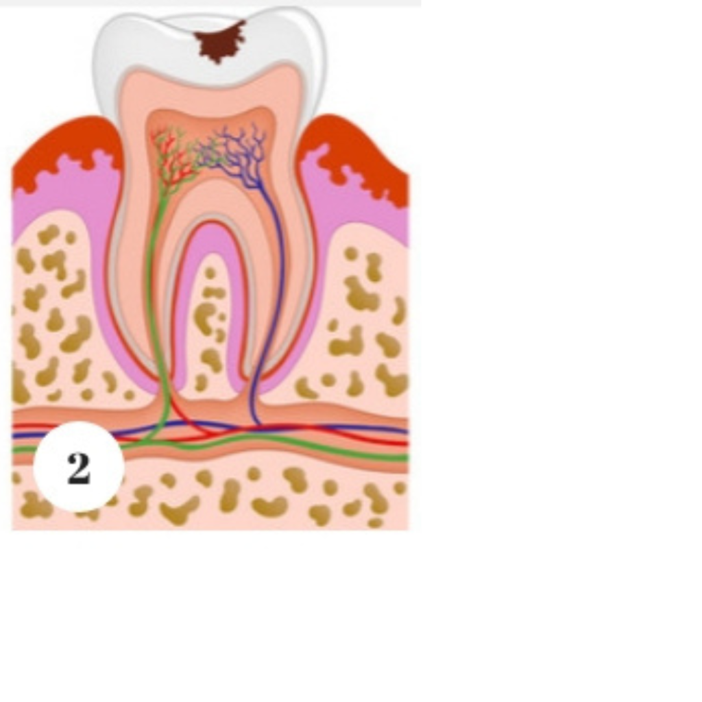 stage 2 of tooth decay