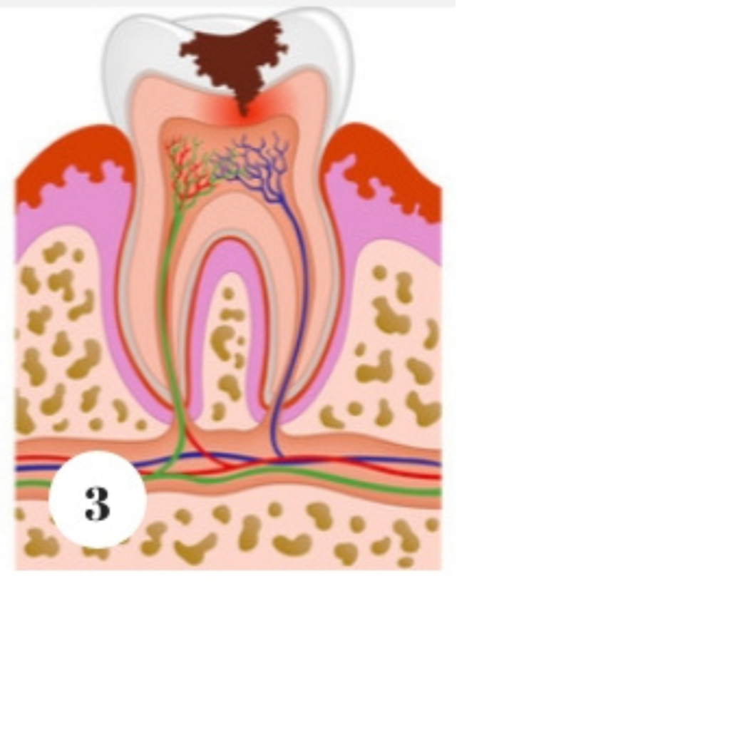 stage 3 of tooth decay diagram