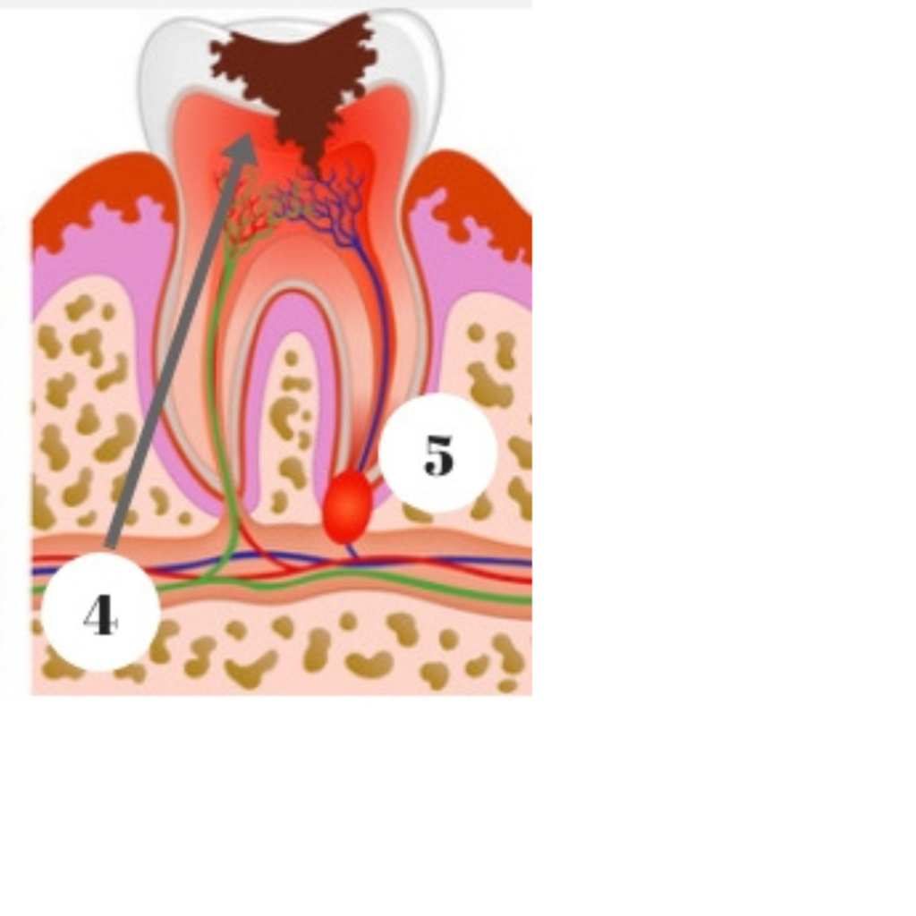 stage 4 of tooth decay diagram
