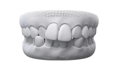 Invisalign crowded teeth