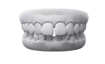 Invisalign gaps between teeth