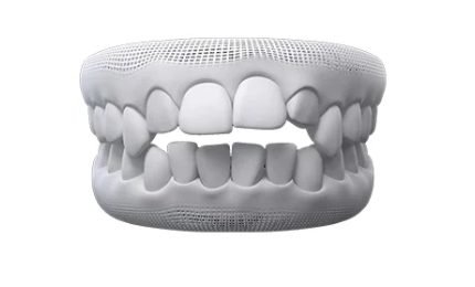 Invisalign Open Bite