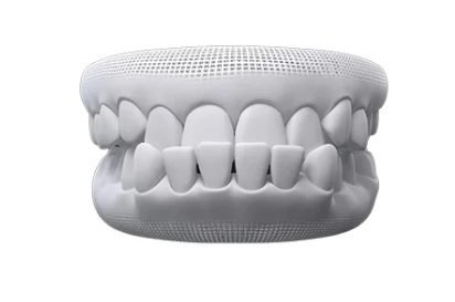 Invisalign underbite