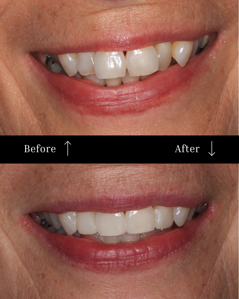 Invisalign before & after