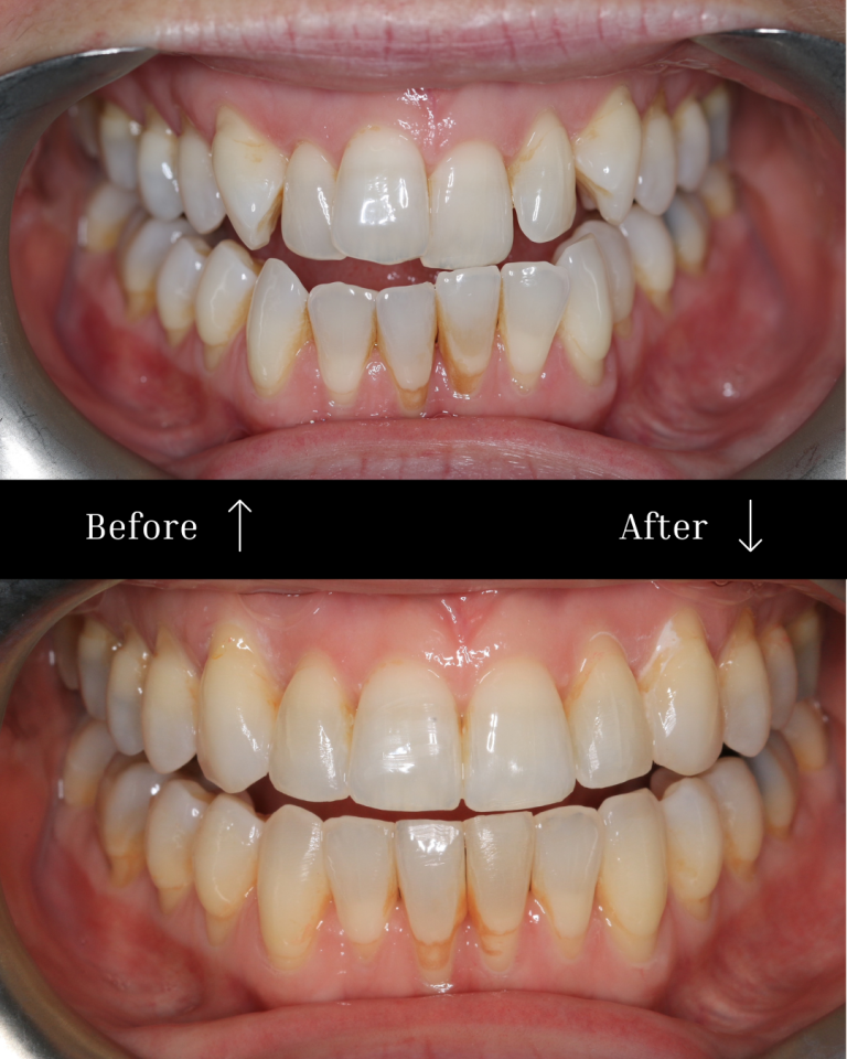 Invisalign before & after
