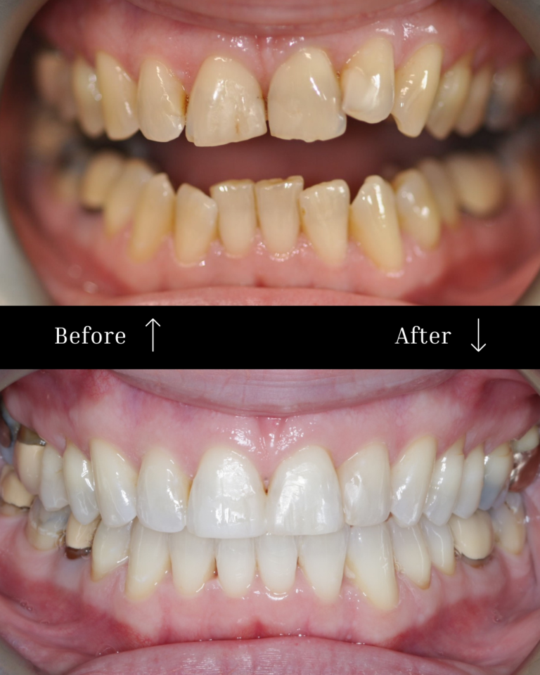 Invisalign before/after