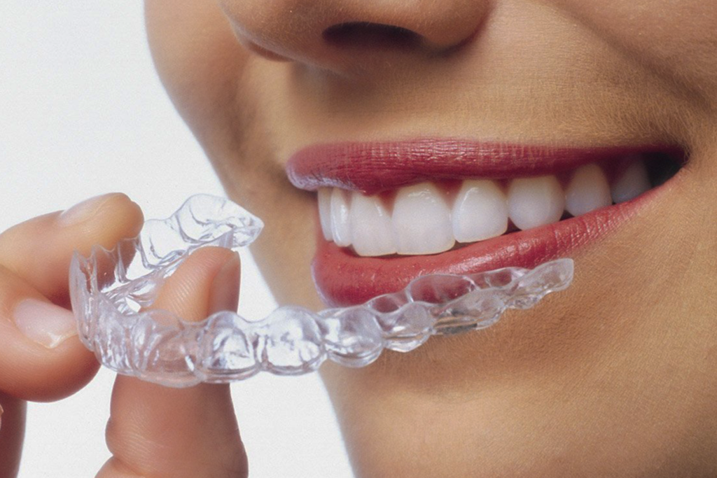 Invisalign in Modbury, Devon.