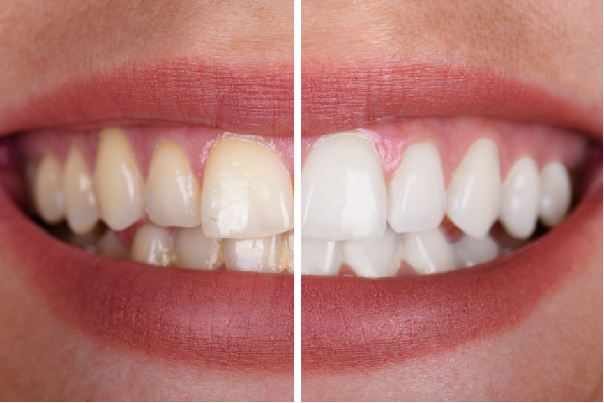 Boutique Whitening results at Modbury Dental Practice.
