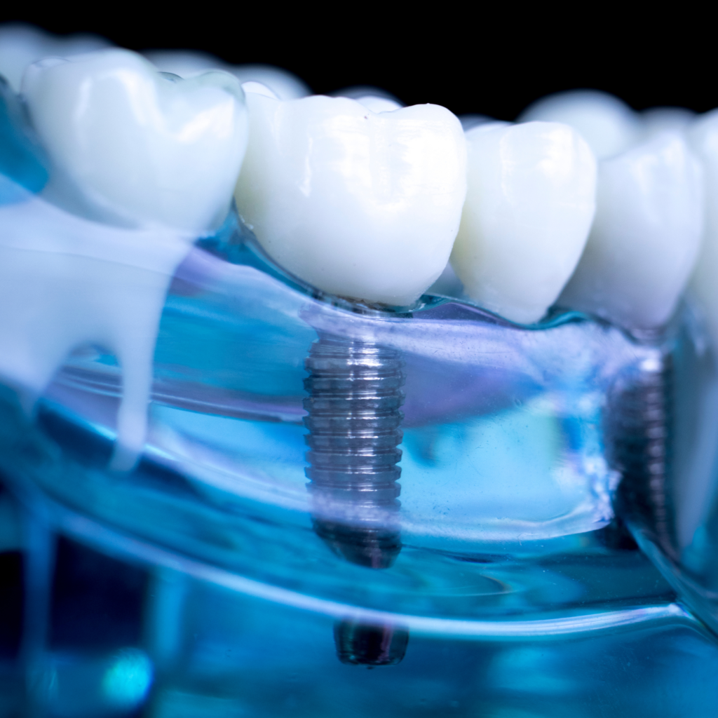 Replace missing teeth with implants at Modbury Dental Practice